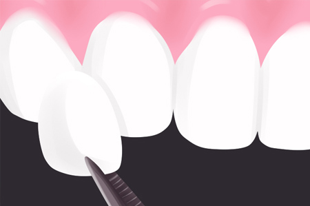 Dental Veneers