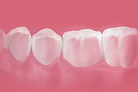Gum Treatment