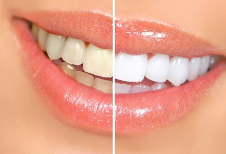 Teeth Whitening Arncliffe