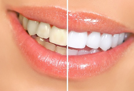 Teeth Whitening
