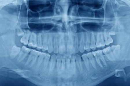 Wisdom Teeth